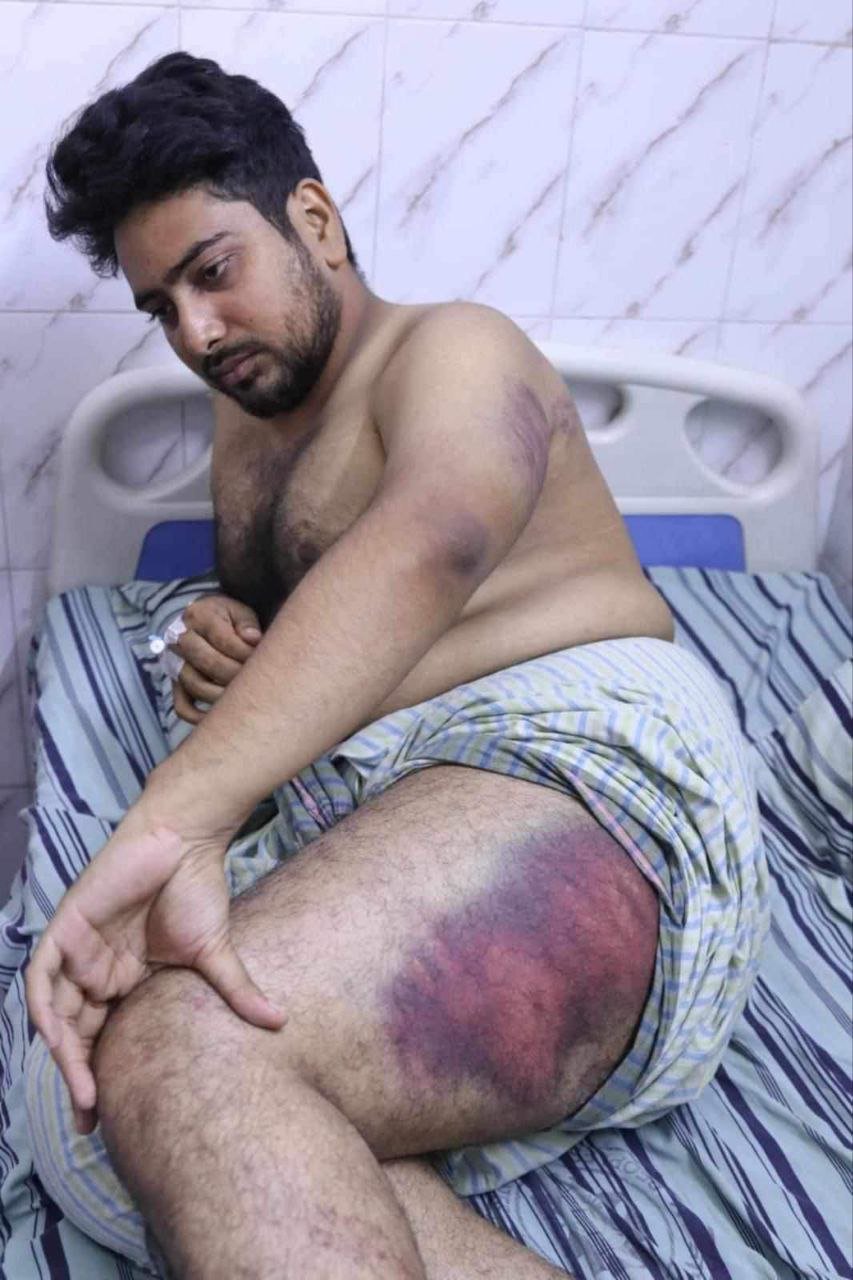 আন্দোলনের সমন্বয়ক নাহিদের উপর কি ধরনের পৈশাচিক নির্যাতন করেছে দেখুন!